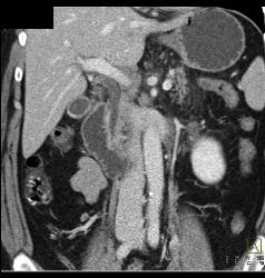 Thickened Duodenum With Mild Inflammatory Disease - CTisus CT Scan