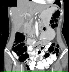 Catheter Left in Small Bowel Lumen - CTisus CT Scan