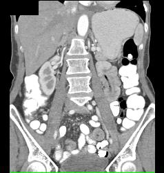 Catheter Left in Small Bowel Lumen - CTisus CT Scan