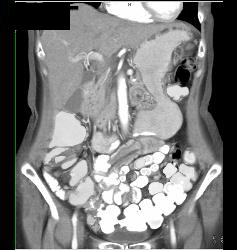 Catheter Left in Small Bowel Lumen - CTisus CT Scan