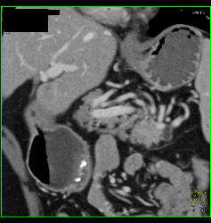 Intraductal Papillary Mucinous Neoplasm (IPMN) With Normal Small Bowel - CTisus CT Scan