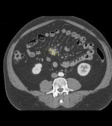 Carcinoid Tumor - CTisus CT Scan