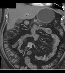 Carcinoid Tumor - CTisus CT Scan