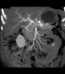 Carcinoid Tumor - CTisus CT Scan