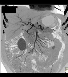 Carcinoid With Liver Metastases - CTisus CT Scan