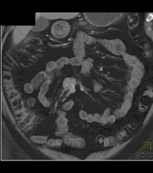 Carcinoid With Liver Metastases - CTisus CT Scan