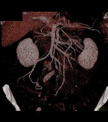 Carcinoid With Liver Metastases - CTisus CT Scan