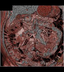 Carcinoid With Liver Metastases - CTisus CT Scan