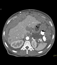 Pseudomyxoma Peritonei (PMP) - CTisus CT Scan