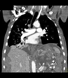 Pseudomyxoma Peritonei (PMP) - CTisus CT Scan