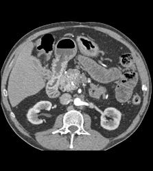 Carcinoid Tumor Extends to Pancreatic Bed - CTisus CT Scan