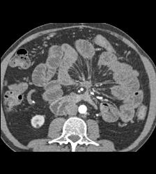 Carcinoid Tumor Extends to Pancreatic Bed - CTisus CT Scan