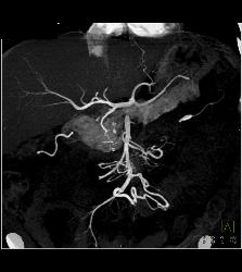 Carcinoid Tumor Extends to Pancreatic Bed - CTisus CT Scan