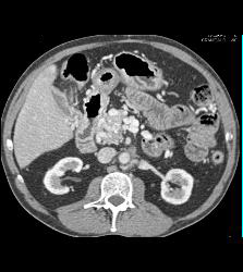 Carcinoid Tumor Extends to Pancreatic Bed - CTisus CT Scan