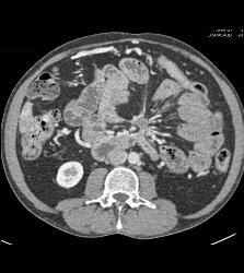 Carcinoid Tumor in the Mesentery Encases the Vessels With Cavernous Transformation of the Portal Vein (CTPV) - CTisus CT Scan