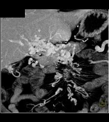 Carcinoid Tumor in the Mesentery Encases the Vessels With Cavernous Transformation of the Portal Vein (CTPV) - CTisus CT Scan