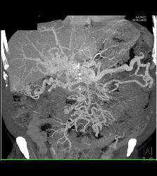 Carcinoid Tumor in the Mesentery Encases the Vessels With Cavernous Transformation of the Portal Vein (CTPV) - CTisus CT Scan