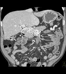 Carcinoid Tumor in the Mesentery Encases the Vessels With Cavernous Transformation of the Portal Vein (CTPV) - CTisus CT Scan