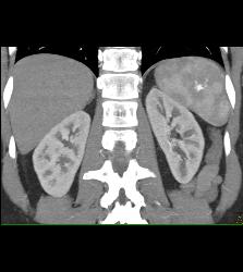 1cm Islet Cell Tumor of the Pancreatic Head With Liver Lesion- See Full Sequence - CTisus CT Scan