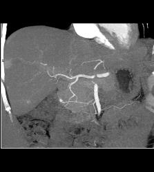 1cm Islet Cell Tumor of the Pancreatic Head With Liver Lesion- See Full Sequence - CTisus CT Scan