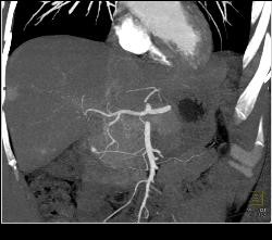 1cm Islet Cell Tumor of the Pancreatic Head With Liver Lesion- See Full Sequence - CTisus CT Scan