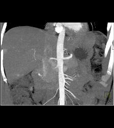 1cm Islet Cell Tumor of the Pancreatic Head With Liver Lesion- See Full Sequence - CTisus CT Scan