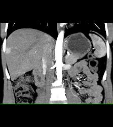 1cm Islet Cell Tumor of the Pancreatic Head With Liver Lesion- See Full Sequence - CTisus CT Scan