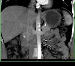 1cm Islet Cell Tumor of the Pancreatic Head With Liver Lesion- See Full Sequence - CTisus CT Scan