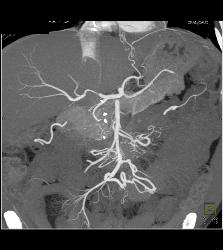 Pancreatic Cancer Arises in the Intraductal Papillary Mucinous Neoplasm (IPMN) and Encases the Gastroduodenal Artery (GDA) - CTisus CT Scan