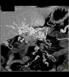 Carcinoid Tumor Encases the PV/SMV With Cavernous Transformation of the Portal Vein (CTPV) - CTisus CT Scan