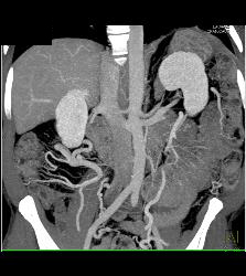 Carcinoid Tumor Encases the PV/SMV With Cavernous Transformation of the Portal Vein (CTPV) - CTisus CT Scan