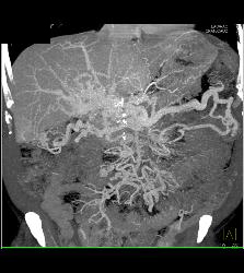 Carcinoid Tumor Encases the PV/SMV With Cavernous Transformation of the Portal Vein (CTPV) - CTisus CT Scan