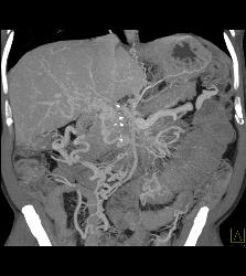 Carcinoid Tumor Encases the PV/SMV With Cavernous Transformation of the Portal Vein (CTPV) - CTisus CT Scan