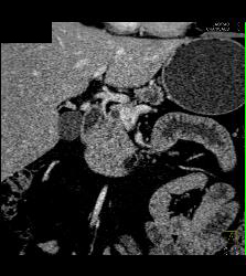 Pancreatic Cancer Obstructs the Pancreatic Duct and Common Bile Duct (CBD) - CTisus CT Scan