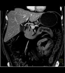 Pancreatic Cancer Obstructs the Pancreatic Duct and Common Bile Duct (CBD) - CTisus CT Scan