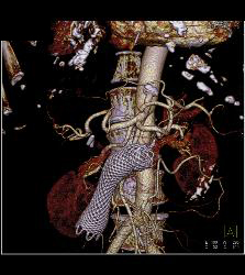 Wall Stent in Duodenum in Patient With Invasive Pancreatic Cancer - CTisus CT Scan