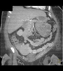 Wall Stent in Duodenum in Patient With Invasive Pancreatic Cancer - CTisus CT Scan