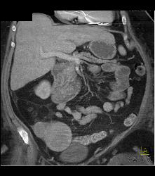 Wall Stent in Duodenum in Patient With Invasive Pancreatic Cancer - CTisus CT Scan