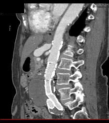 Narrowing Origin of Celiac Artery With Celiac Artery Aneurysm - CTisus CT Scan