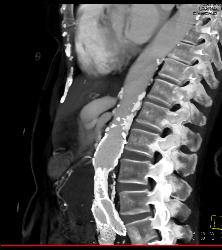 Narrowing Origin of Celiac Artery With Celiac Artery Aneurysm - CTisus CT Scan