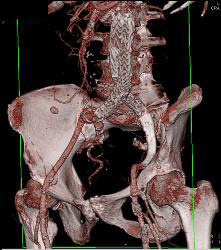 Narrowing Origin of Celiac Artery With Celiac Artery Aneurysm - CTisus CT Scan