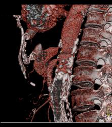 Narrowing Origin of Celiac Artery With Celiac Artery Aneurysm - CTisus CT Scan