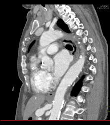 Narrowing Origin of Celiac Artery With Celiac Artery Aneurysm - CTisus CT Scan