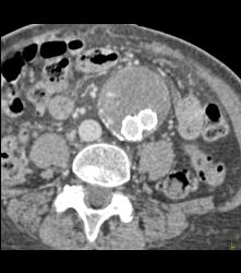 the Patient Also Had An Endovascular Stent With Endoleak - CTisus CT Scan