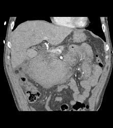 Large Hematoma Simulates A Mass That Bleeds. No Mass Is Seen and None Was Found At Surgery - CTisus CT Scan