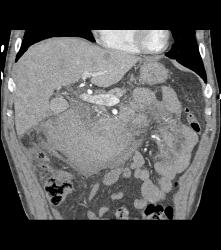 Large Hematoma Simulates A Mass That Bleeds. No Mass Is Seen and None Was Found At Surgery - CTisus CT Scan