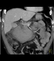 Large Hematoma Simulates A Mass That Bleeds. No Mass Is Seen and None Was Found At Surgery - CTisus CT Scan