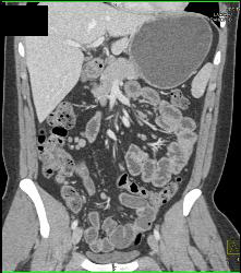 Increased Fat in Mesentery - CTisus CT Scan