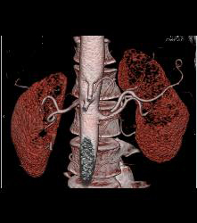 Normal Mesenteric Vasculature - CTisus CT Scan