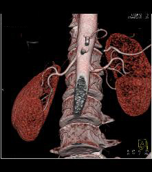 Normal Mesenteric Vasculature - CTisus CT Scan